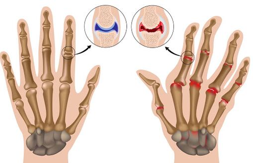 Arthritis and its manifestation