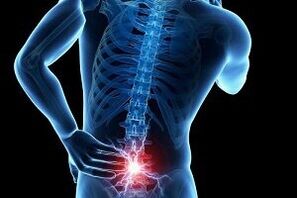 back pain with osteochondrosis