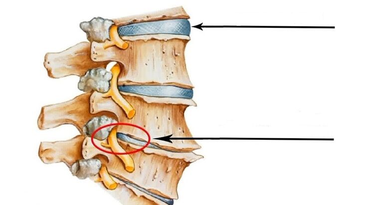 spinal cord injury in case of osteochondrosis of the cervix