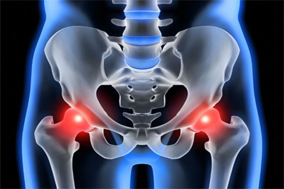 Deformative arthritis of the hip joints (coxarthrosis)