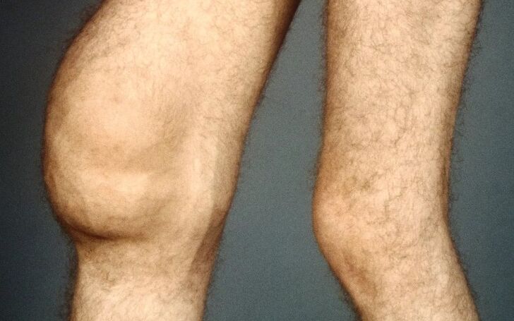Post -traumatic articulation of the knee joint