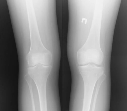 The x -ray of the knee joint