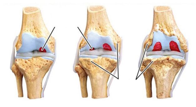 Complications of joint articles