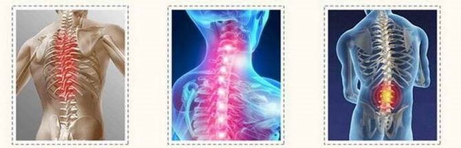 osteochondroes vertebral lesions