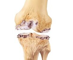 damage to the knee joint due to arthropathy