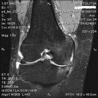 Osteoarthritis of the knee joint on magnetic resonance imaging